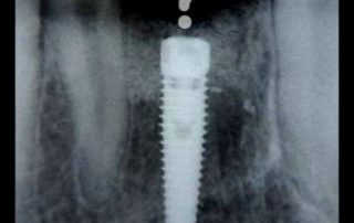 Prosthodontic