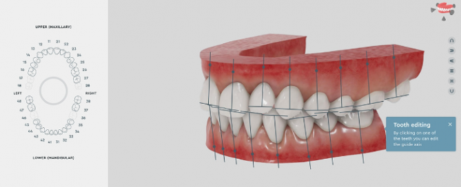 Alignova Orthodontic Clear Aligner Treatment Plan By Dentinova
