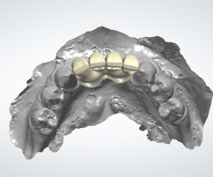 Dentinova-Bridge-on-implants-Design