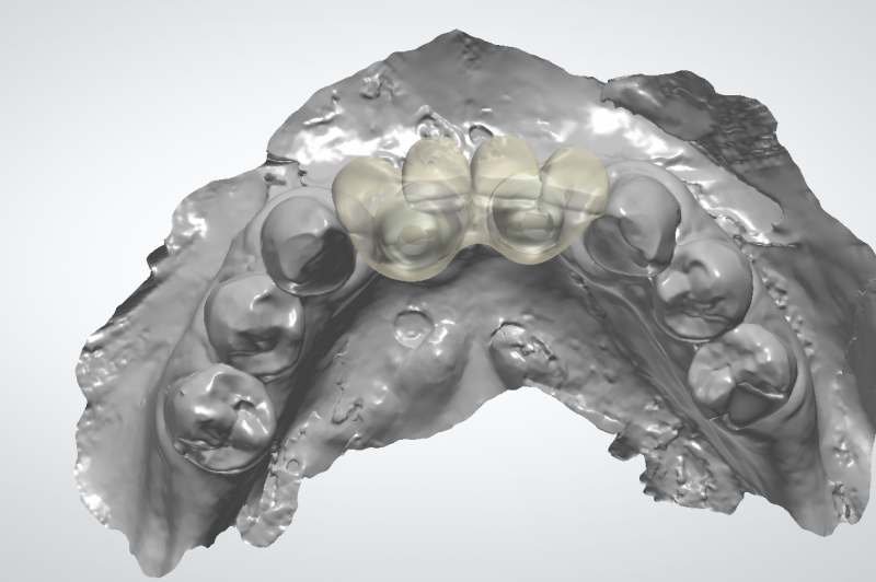 Dentinova-Bridge-on-implants-Design