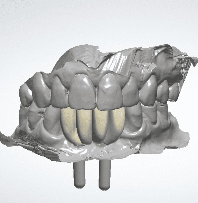 Dentinova-Bridge-on-implants-Design
