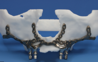 Prosthodontic PSI