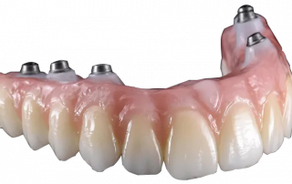 Prosthodontic Fullarch Design & Fabrication