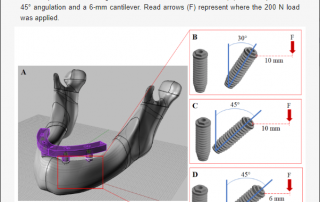 Effect of Angulation of posterior implants on All on 4 Full-arch-prosthesis