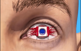tooth in eye surgery جراحة السن في العين