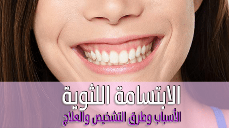 الابتسامة اللثوية -الأسباب-وطرق-التشخيص-والعلاج