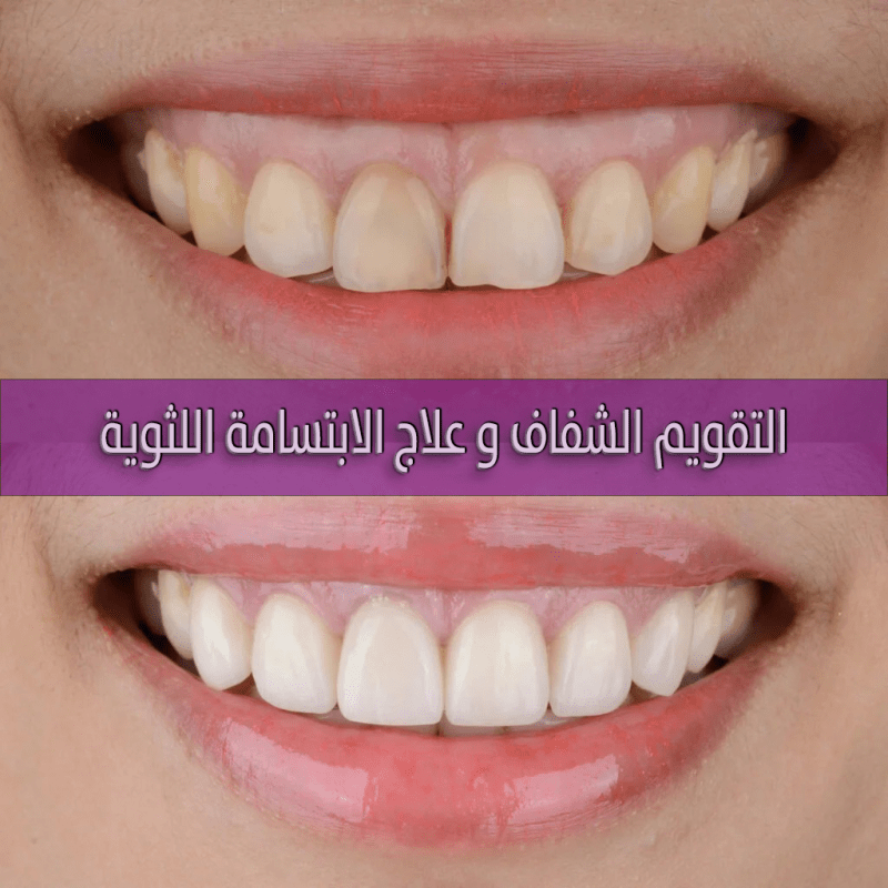 التقويم الشفاف و علاج الابتسامة اللثوية