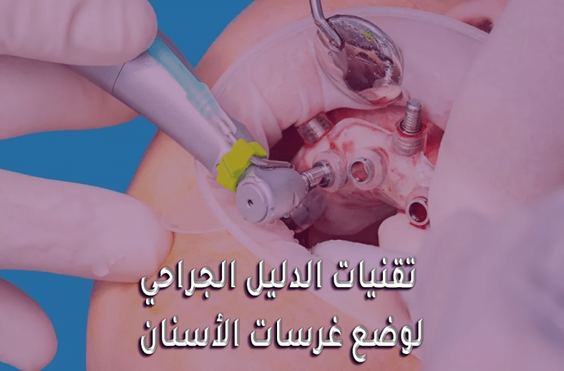 تقنيات الدليل الجراحي لوضع غرسات الأسنان