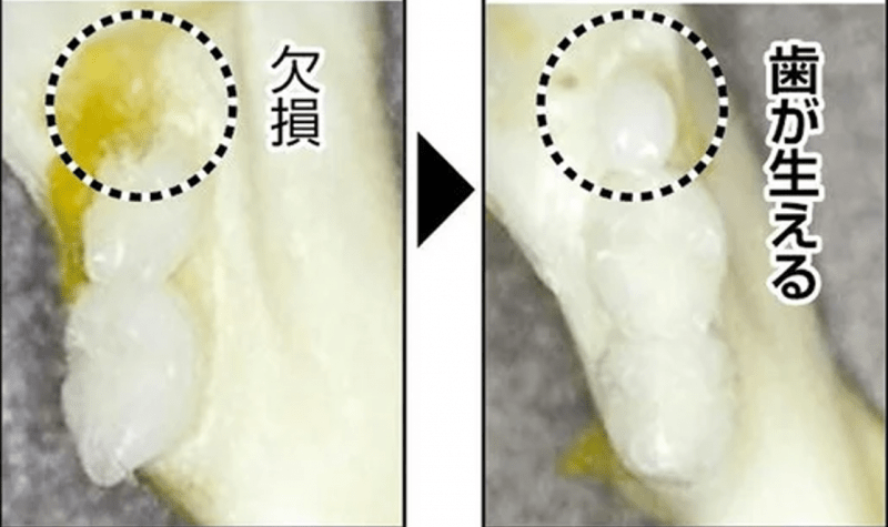 A Breakthrough in Teeth Regeneration: First Human Trials Begin This Month
