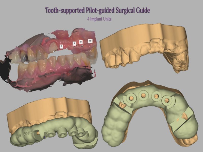 زراعة الأسنان بين الزراعة الموجّهة وتقنية اليد الحرّة