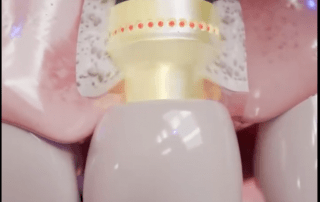 The Smart Dental Implants