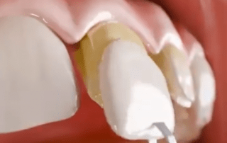 How Dental Veneers Are Made-Dentinova