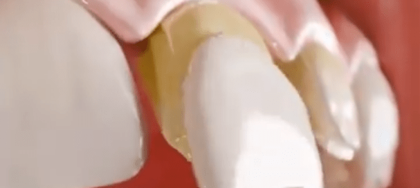 How Dental Veneers Are Made-Dentinova