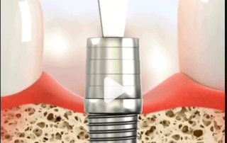 Reasons for loose healing abutments Dentinova