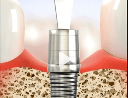 Reasons of Loose Healing Abutments on Dental Implants