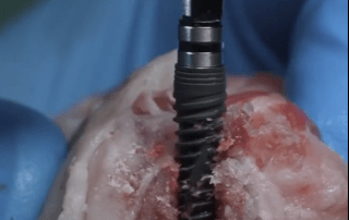The Art of Precision A Masterclass in Dental Implant Drilling- Dentinova