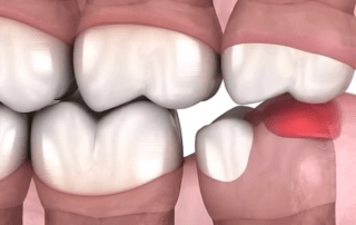 Understanding Pericoronitis And Its Link To Wisdom Teeth - Dentinova