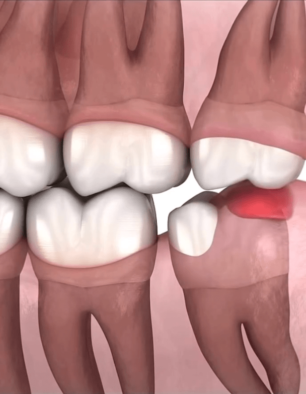 Understanding Pericoronitis And Its Link To Wisdom Teeth - Dentinova