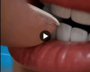 Why-you-shouldnt-bite-your-nails-Dentinova