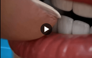 Why-you-shouldnt-bite-your-nails-Dentinova