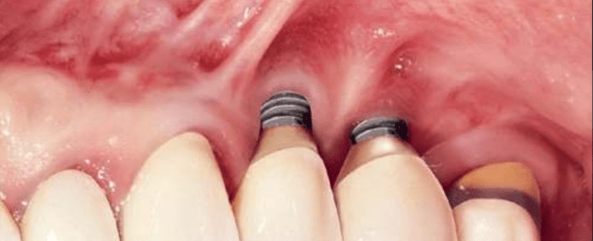 Periodontic Secret in Implant Success By Carlo Tinti