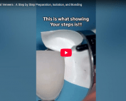 Esthetic Dental Veneers A Step-by-Step Preparation