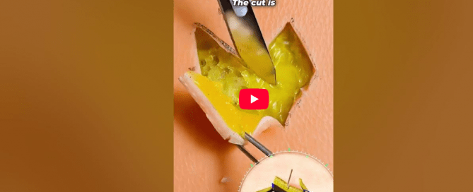 Rhomboid Incision in Dental Surgery A Valuable Technique for Soft Tissue Reconstruction