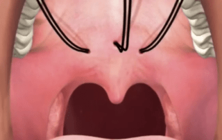 Say Goodbye to Snoring and Sleep Apnea with Elvoplasty Your Ticket to Dreamland Awaits!