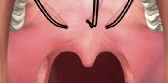 Say Goodbye to Snoring and Sleep Apnea with Elvoplasty Your Ticket to Dreamland Awaits!