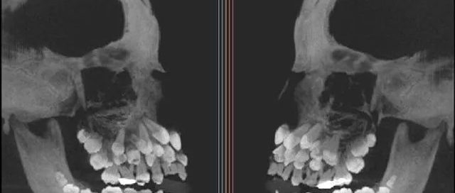 dr katsu takahashi third set of teeth