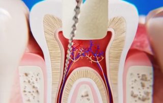 Broken Endodontic Files Causes, Implications, and Retrieval