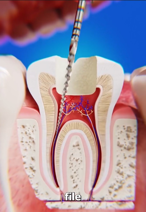 Broken Endodontic Files Causes, Implications, and Retrieval