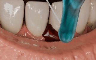 How Delayed Flossing Causes Gum Bleeding