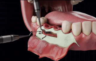IAN Lateralization, along with its counterpart IAN Transposition, are specialized surgical techniques that allow clinicians to safely navigate this challenge.