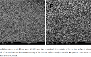 Laser-Assisted MTA Precipitation on Root Canal Dentin