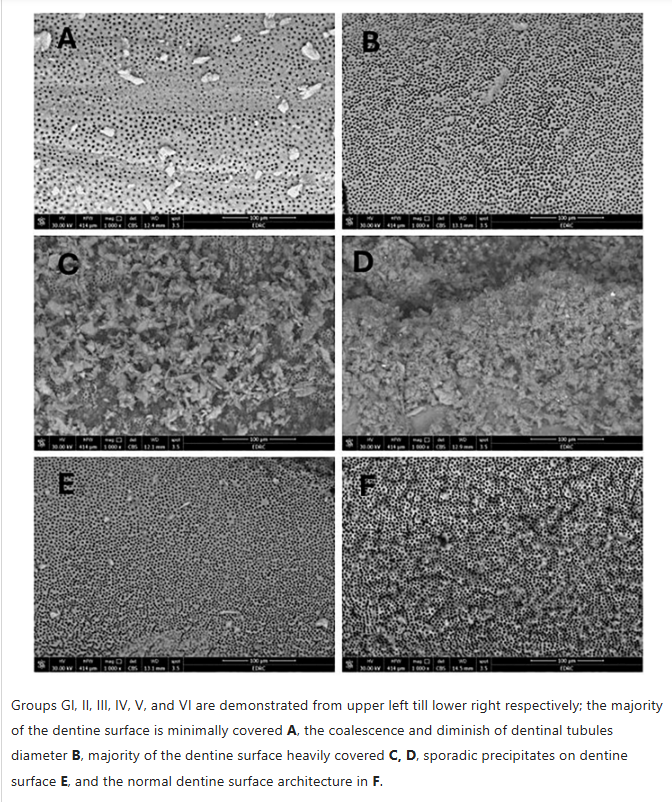 Laser-Assisted MTA Precipitation on Root Canal Dentin in endodontics