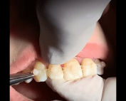 Closing Diastemas With Composite Attachments and Elastics