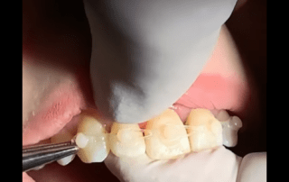 Closing Diastemas With Composite Attachments and Elastics