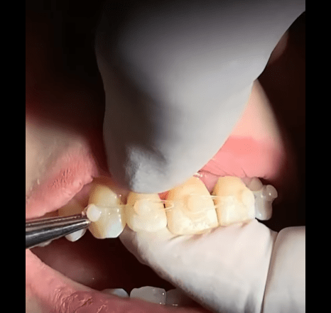 Closing Diastemas With Composite Attachments and Elastics