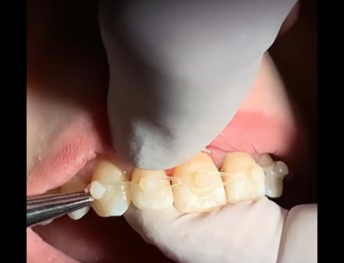 Closing Diastemas With Composite Attachments and Elastics