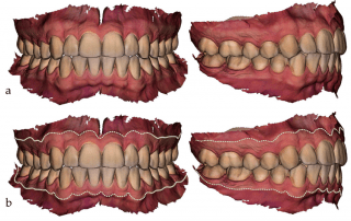 A Breakthrough for Gingival Inflammation Detection Using IOS