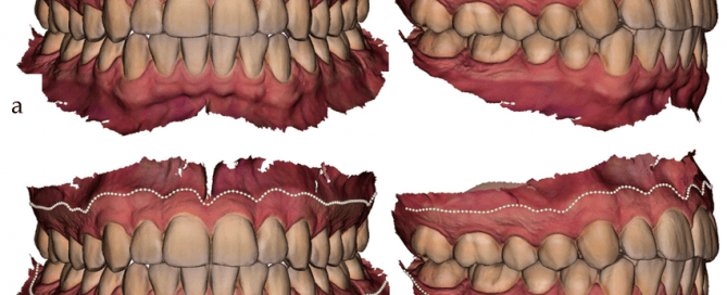 A Breakthrough for Gingival Inflammation Detection Using IOS