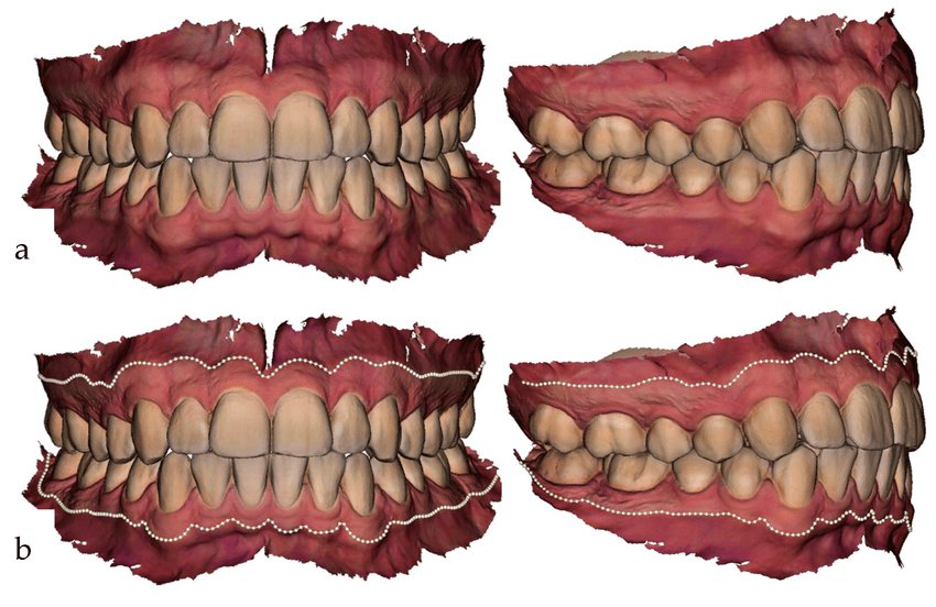 A Breakthrough for Gingival Inflammation Detection Using IOS