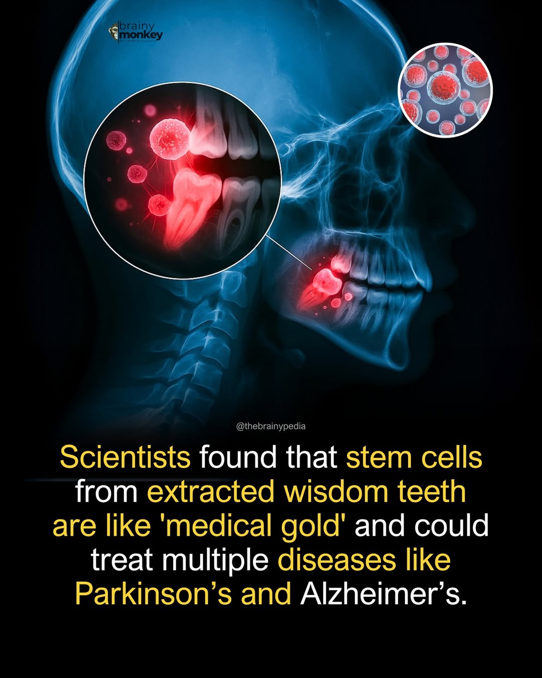 Stem Cells from Wisdom Teeth Could Revolutionize Medicine
