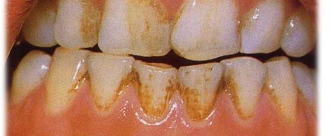 Swimmer's Plaque or Swimmer's Calculus