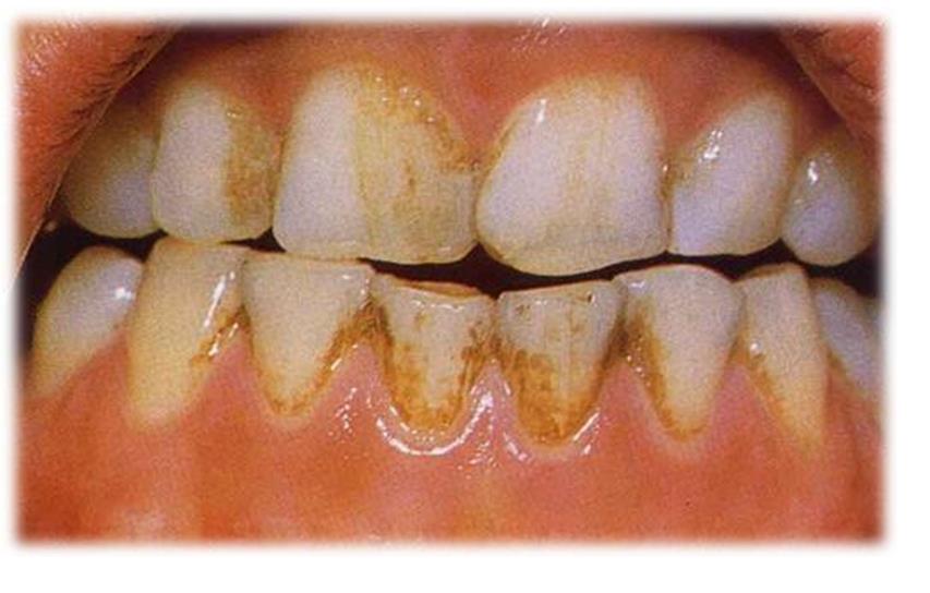 Swimmer's Plaque or Swimmer's Calculus