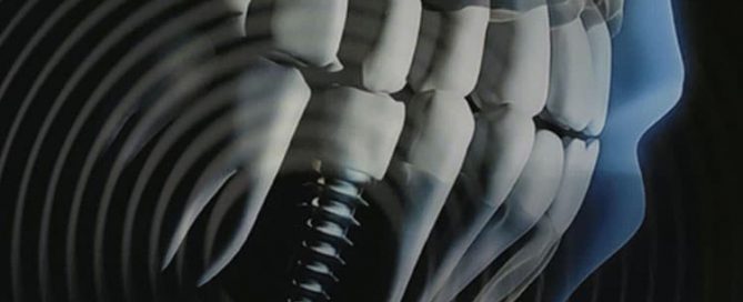 Woman's Hearing Restored By Routine Dental Implant Surgery