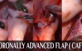Coronally Advanced Flap " CAF " Around Implants: Techniques & Outcomes