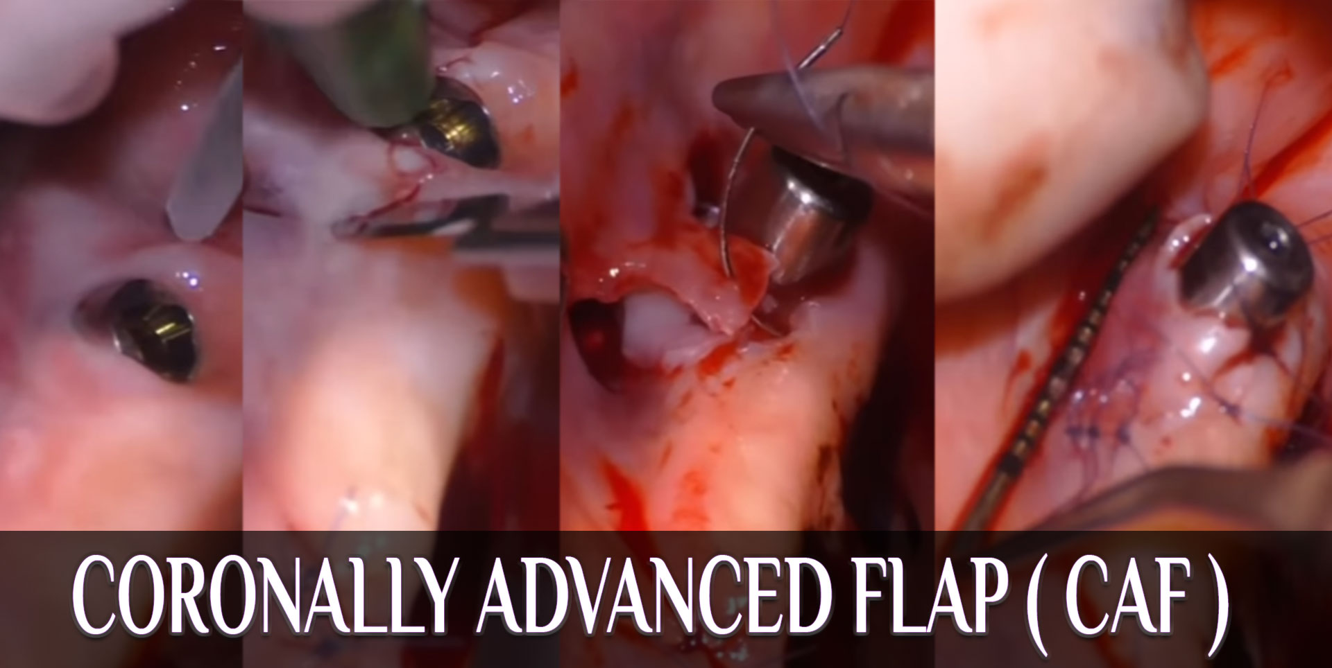 Coronally Advanced Flap " CAF " Around Implants: Techniques & Outcomes