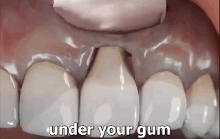  Explore-the-role-of-dead-skin-in-developing-new-gingiva,-advancing-periodontal-therapy-and-soft-tissue-reconstruction-for-dental-specialists.